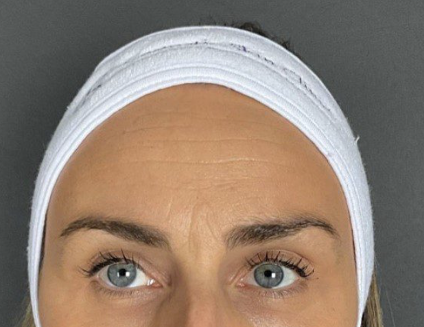 After Treatment