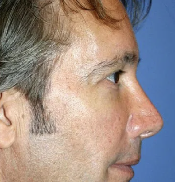 After Treatment