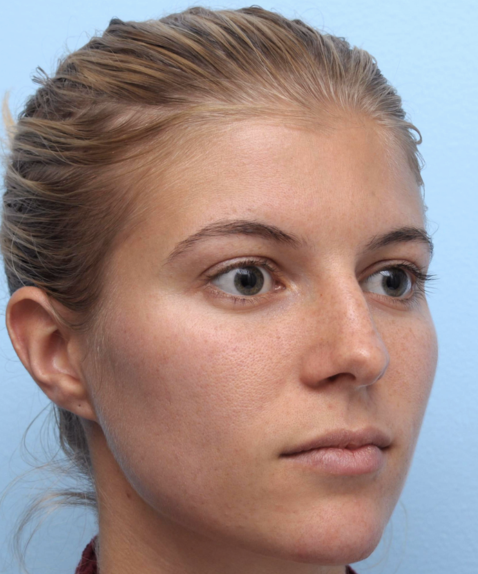 After Treatment