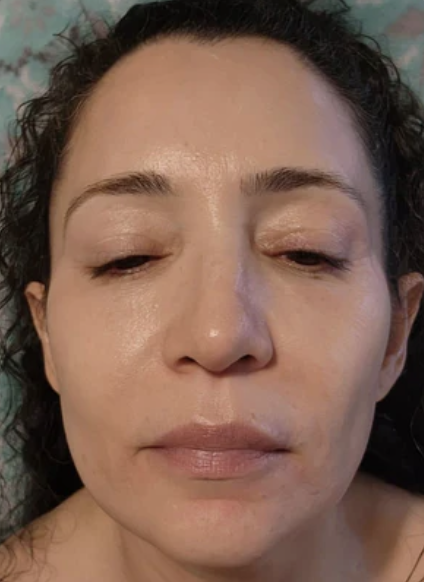After Treatment