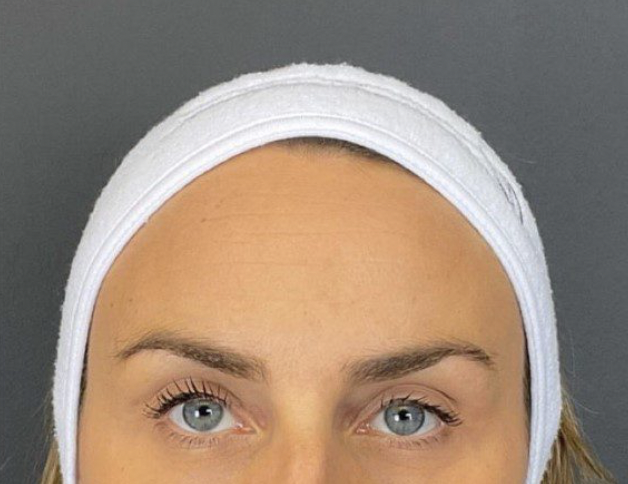 Before Treatment