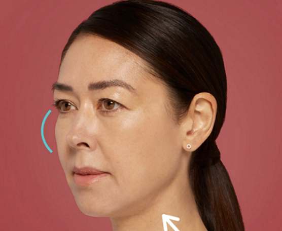 Before Treatment
