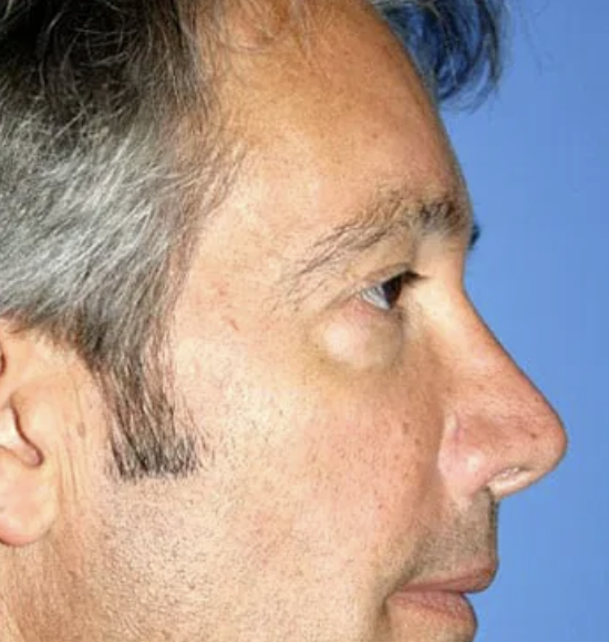 Before Treatment