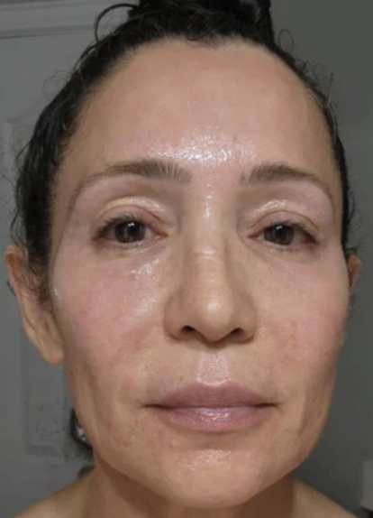Before Treatment