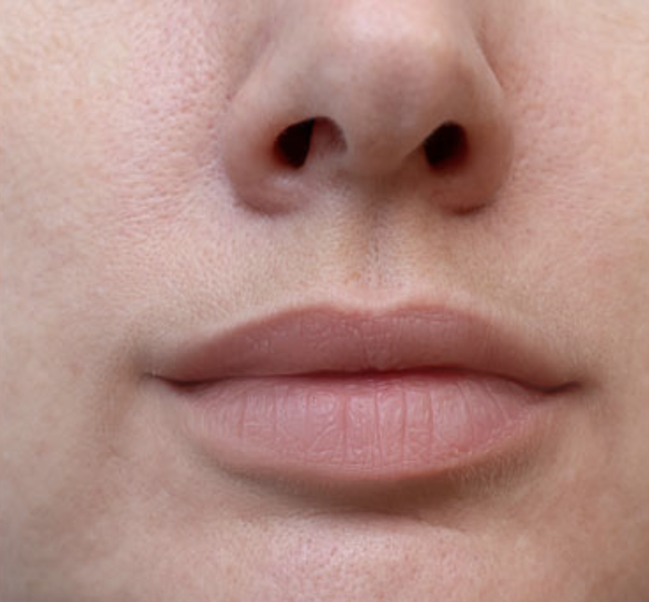 After Treatment