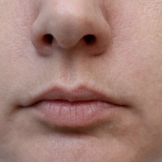 Before Treatment